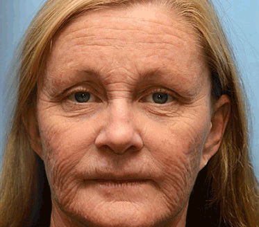 🐝 🎁 Már csak az utolsó 5 doboz maradt! Korlátozott ideig extra 50% kedvezmény! Ragadd meg a lehetőséget a bőröd újjászületéséhez ✨ Ha most lemaradsz, legközelebb csak jövőre lesz esélyed!